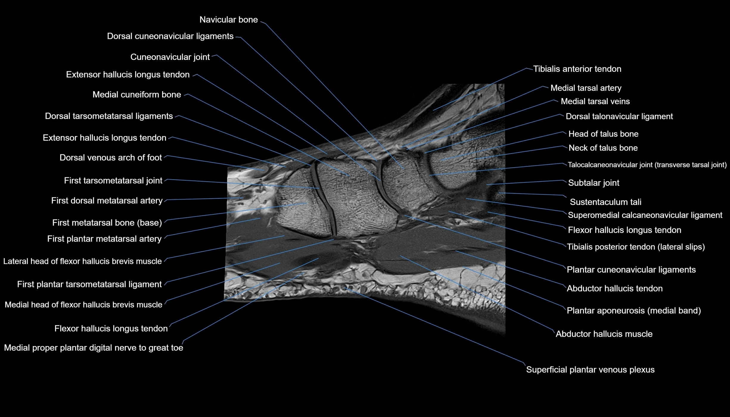 MRI mid foot sagittal cross sectional anatomy 3T  radiology  image-img-00001-00031.webp